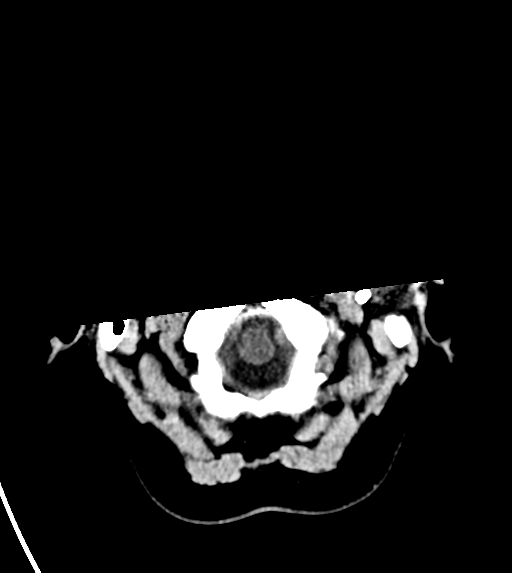 File:Cerebral venous infarct related to dural venous sinus thromboses (Radiopaedia 35292-36804 Axial non-contrast 3).png
