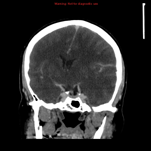 Cerebral venous infarction (Radiopaedia 12404-20735 B 36).jpg
