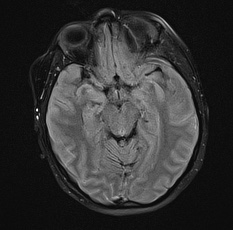 File:Cerebral venous infarction - hemorrhagic (Radiopaedia 81625-95505 Axial FLAIR 11).jpg