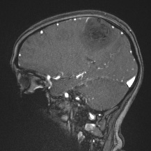 Cerebral venous infarction - hemorrhagic (Radiopaedia 81625-95505 Sagittal MRV 30).jpg