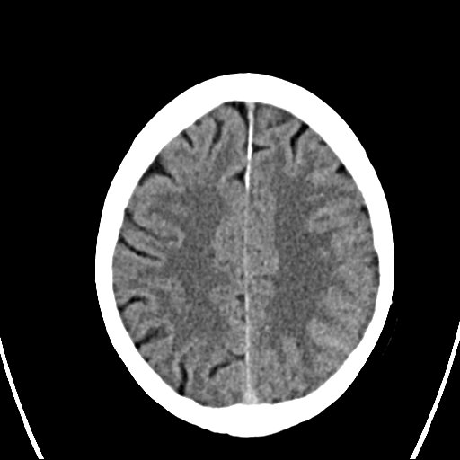 File:Cerebral venous infarction with hemorrhage (Radiopaedia 65343-74381 Axial non-contrast 19).jpg