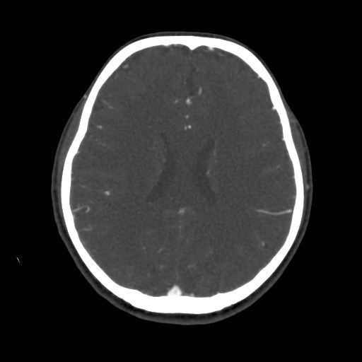 Cerebral venous sinus thrombosis (Radiopaedia 40619-43227 A 142).jpg