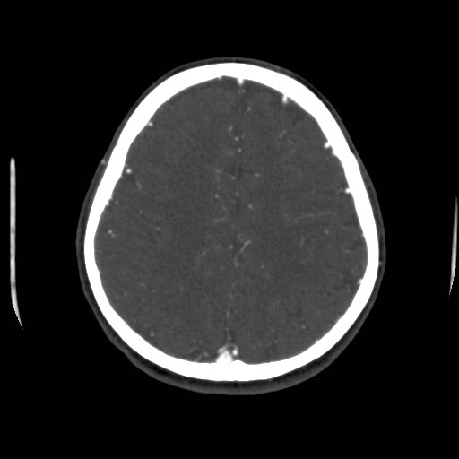 Cerebral venous sinus thrombosis (Radiopaedia 40619-43227 A 170).jpg