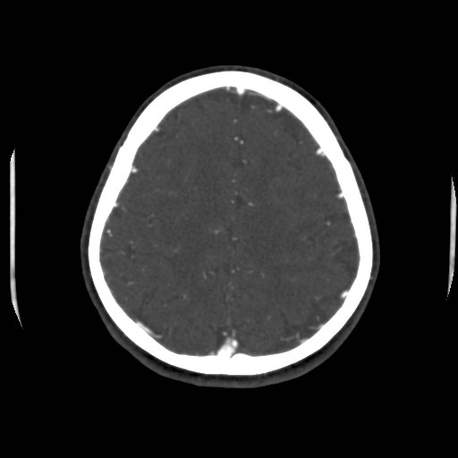Cerebral venous sinus thrombosis (Radiopaedia 40619-43227 A 178).jpg