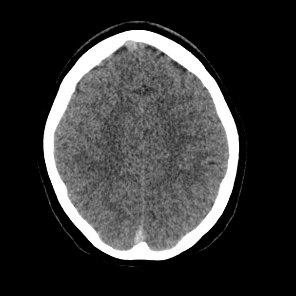 Cerebral venous sinus thrombosis (Radiopaedia 59224-66551 Axial non-contrast 32).jpg