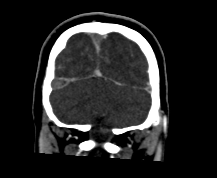 Cerebral venous sinus thrombosis (Radiopaedia 59224-66646 Coronal C+ delayed 66).jpg