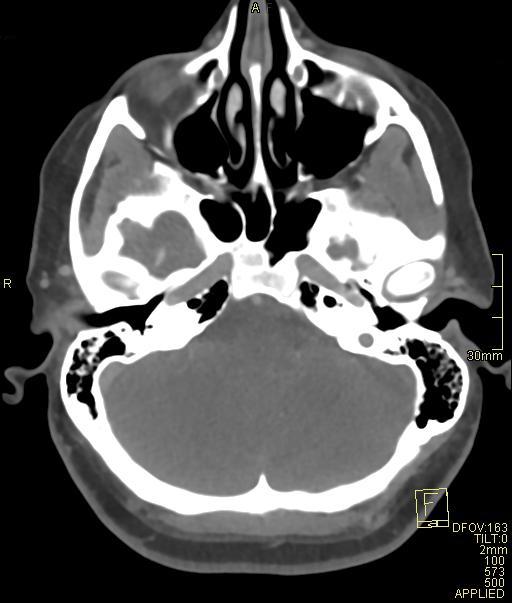 Cerebral venous sinus thrombosis (Radiopaedia 91329-108965 Axial venogram 20).jpg