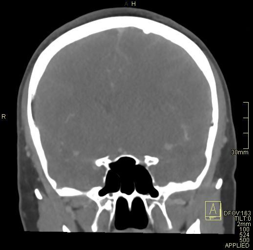 File:Cerebral venous sinus thrombosis (Radiopaedia 91329-108965 Coronal venogram 35).jpg