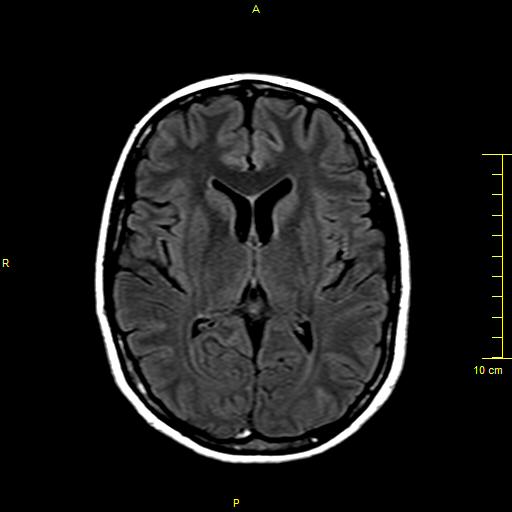 File:Cerebral venous thrombosis (Radiopaedia 23288-23351 Axial FLAIR 10).JPG