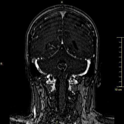 Cerebral venous thrombosis (Radiopaedia 23288-23351 MRV 116).JPG