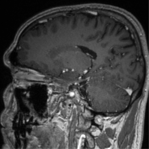 Cerebral venous thrombosis (Radiopaedia 38392-40469 Sagittal T1 C+ 54).png