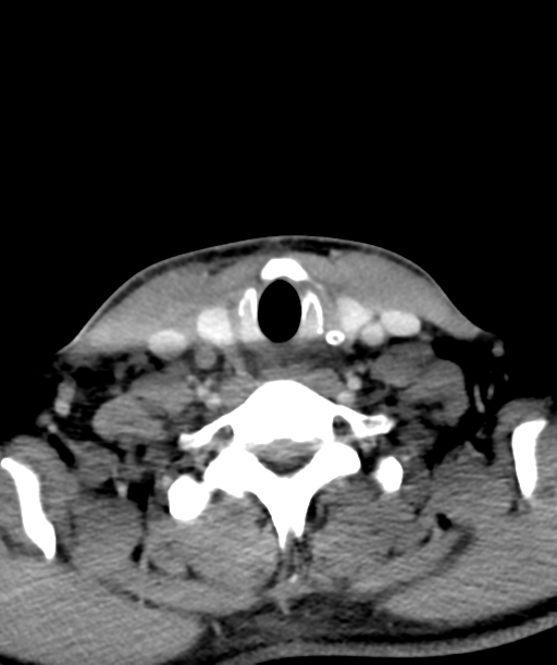 Cervical abscess (Radiopaedia 43725-47184 A 52).png
