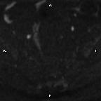 Cervical adenocarcinoma (Radiopaedia 65011-73985 Axial DWI 75).jpg