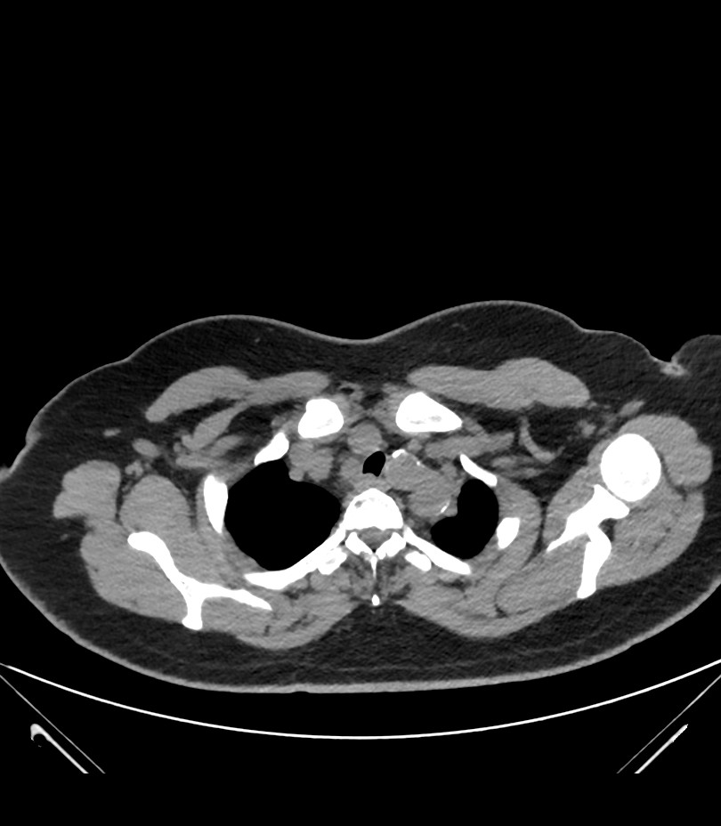 Cervical aortic arch with coarctation and aneurysms (Radiopaedia 44035-47552 Axial non-contrast 12).jpg