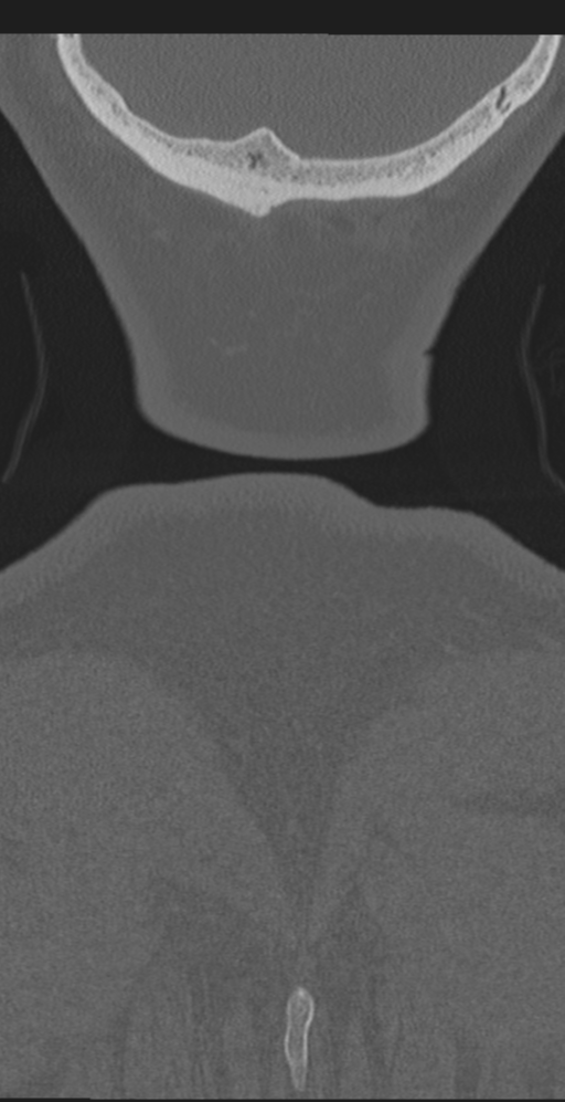 Cervical canal stenosis due to ossification of the posterior longitudinal ligament (Radiopaedia 47260-51823 Coronal bone window 77).png