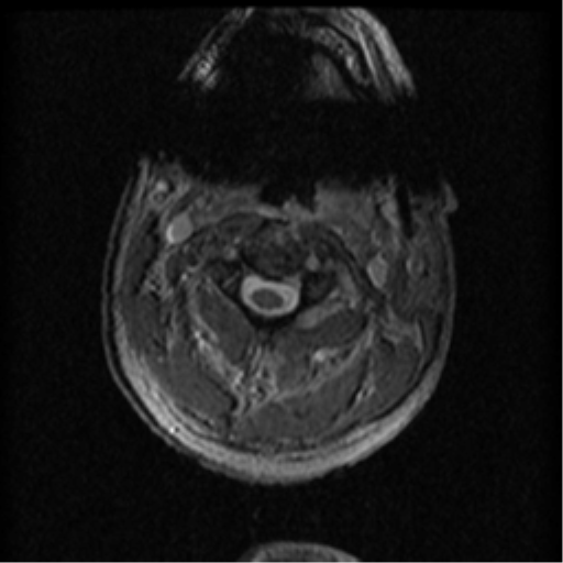 Cervical canal stenosis with cord compression (Radiopaedia 34114-35374 Axial Gradient Echo 79).png