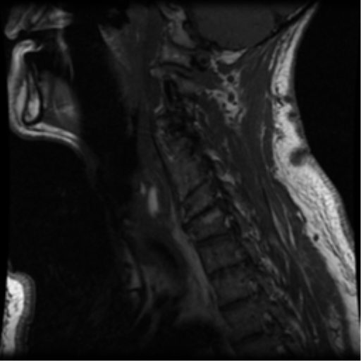 File:Cervical canal stenosis with cord compression (Radiopaedia 34114-35374 Sagittal T1 4).png