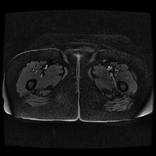 Cervical carcinoma (Radiopaedia 70924-81132 Axial T1 C+ fat sat 8).jpg