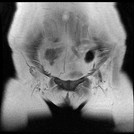 File:Cervical carcinoma (Radiopaedia 88010-104555 Coronal T1 1).jpg