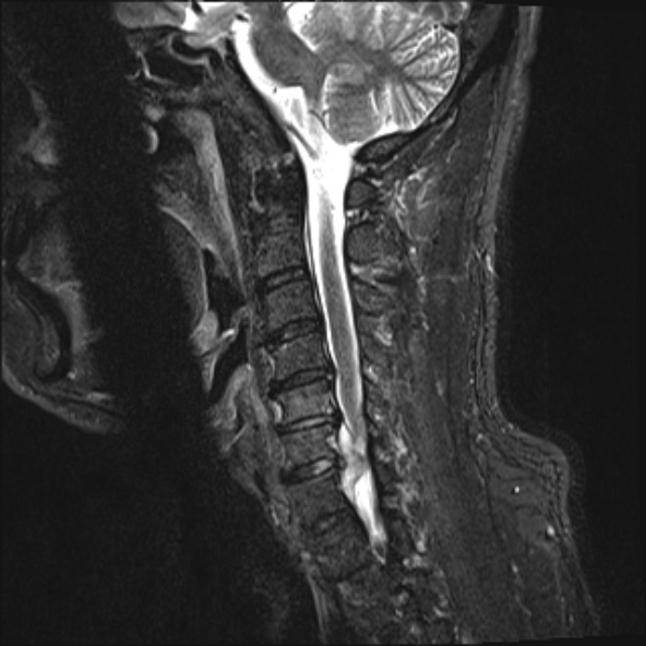 File:Cervical disc extrusion (Radiopaedia 53950-60077 Sagittal STIR 8).jpg