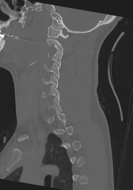 Cervical intercalary bone (Radiopaedia 35211-36748 Sagittal bone window 54).png