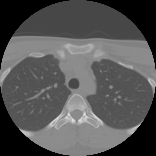 Cervical rib (Radiopaedia 71110-81363 Axial non-contrast 63).jpg