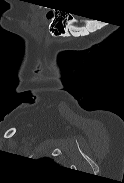 Cervical spine ACDF loosening (Radiopaedia 48998-54070 Sagittal bone window 5).png