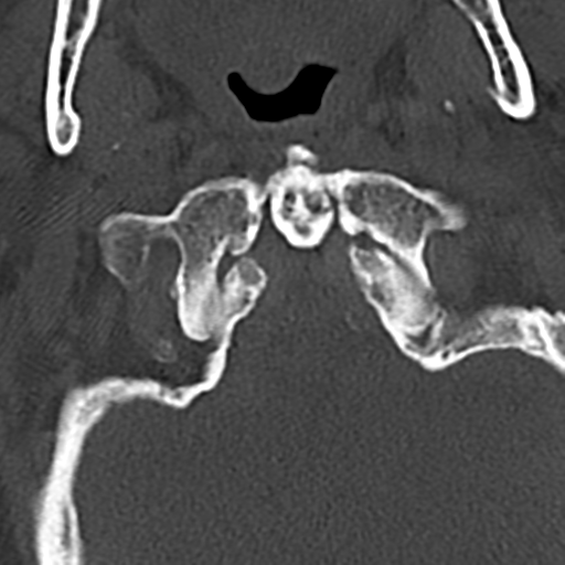 File:Cervical spine fracture - chalk stick (Radiopaedia 39116-41323 Axial bone window 14).png