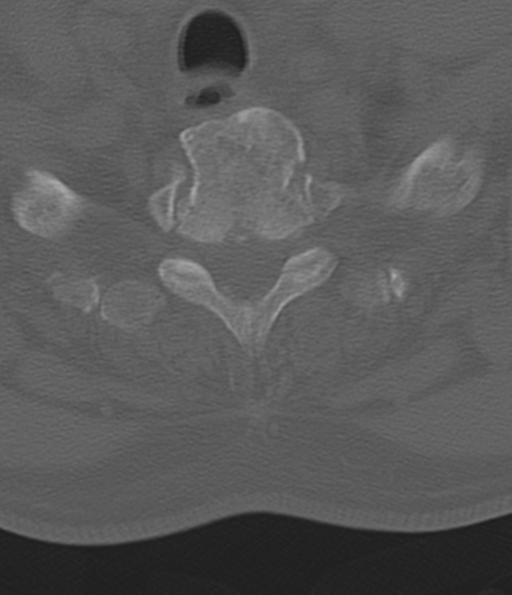 Cervical spine fracture in the setting of ankylosis (Radiopaedia 37038-38715 Axial bone window 53).png
