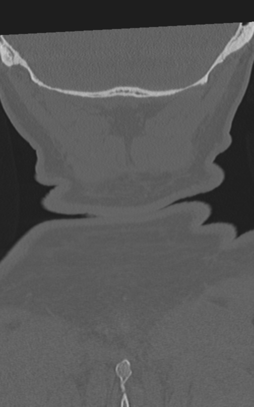 Cervical spine fractures with vertebral artery dissection (Radiopaedia 53296-59268 Coronal bone window 69).png
