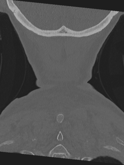 Cervical spondylolysis (Radiopaedia 49616-54811 Coronal bone window 61).png