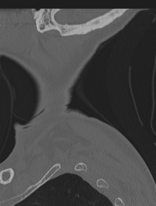 Cervical spondylolysis (Radiopaedia 49616-54811 Sagittal bone window 2).png