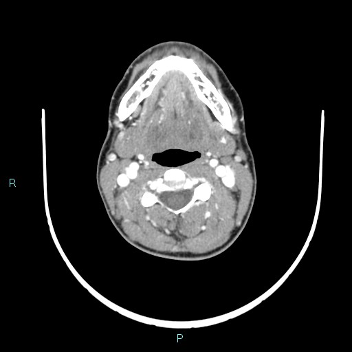 Cervical thymic cyst (Radiopaedia 88632-105335 B 73).jpg