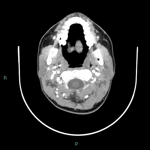 Cervical thymic cyst (Radiopaedia 88632-105335 B 88).jpg