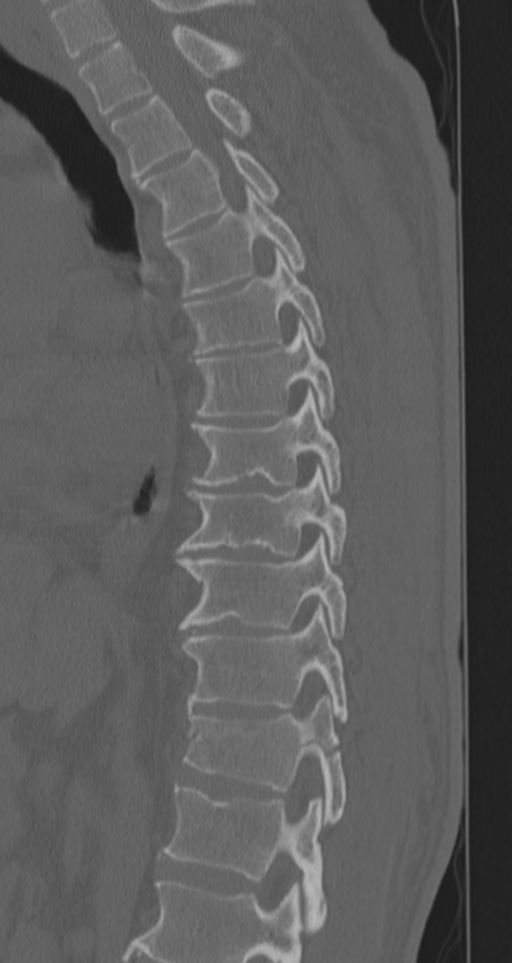 Chance fracture (Radiopaedia 33854-35020 Sagittal bone window 50).png