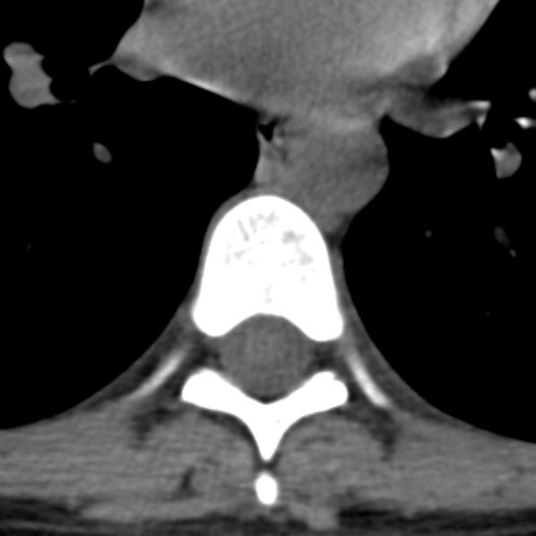 File:Chance fracture (Radiopaedia 36521-38081 Axial non-contrast 11).jpg