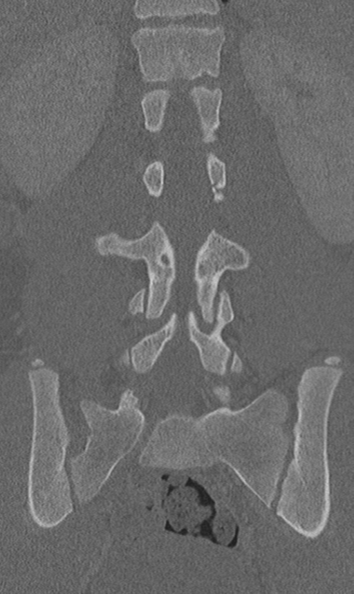 Chance fracture (Radiopaedia 40360-42912 Coronal bone window 41).png