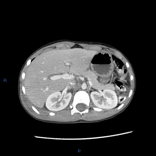 File:Chance fracture with duodenal and pancreatic lacerations (Radiopaedia 43477-46864 A 2).jpg