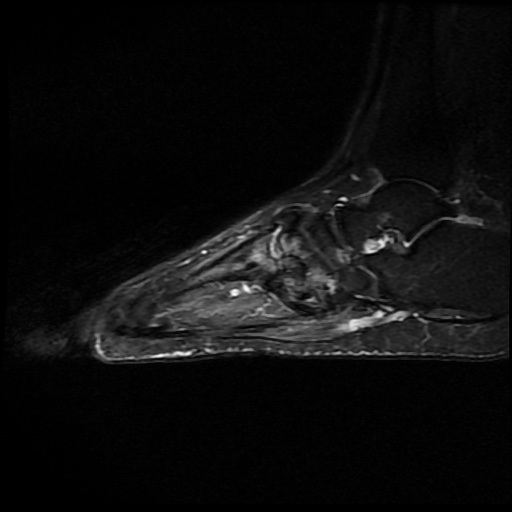 File:Charcot arthropathy (Radiopaedia 55056-61422 Sagittal T2 fat sat 10).jpg