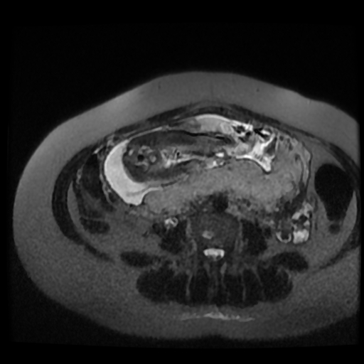 Chiari II malformation - fetal MRI (Radiopaedia 68099-77581 Axial T2-SSFSE 11).jpg