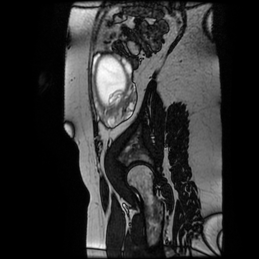File:Chiari II malformation - fetal MRI (Radiopaedia 68099-77581 Sagittal Fiesta 6).jpg