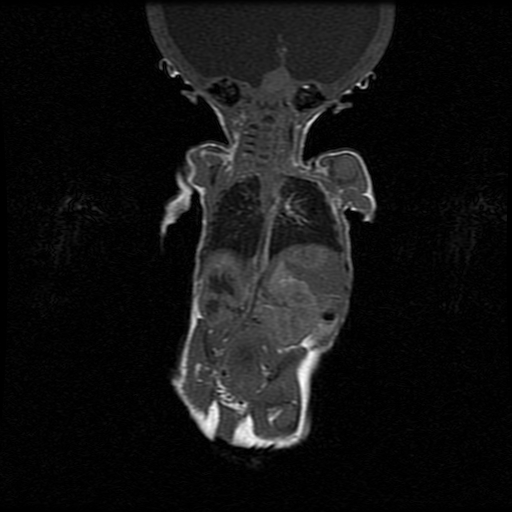 File:Chiari II malformation with spinal meningomyelocele (Radiopaedia 23550-23652 Coronal T1 3).jpg