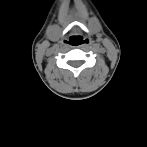 Chiari I malformation and obstructive hydrocephalus (Radiopaedia 41185-43981 D 52).png