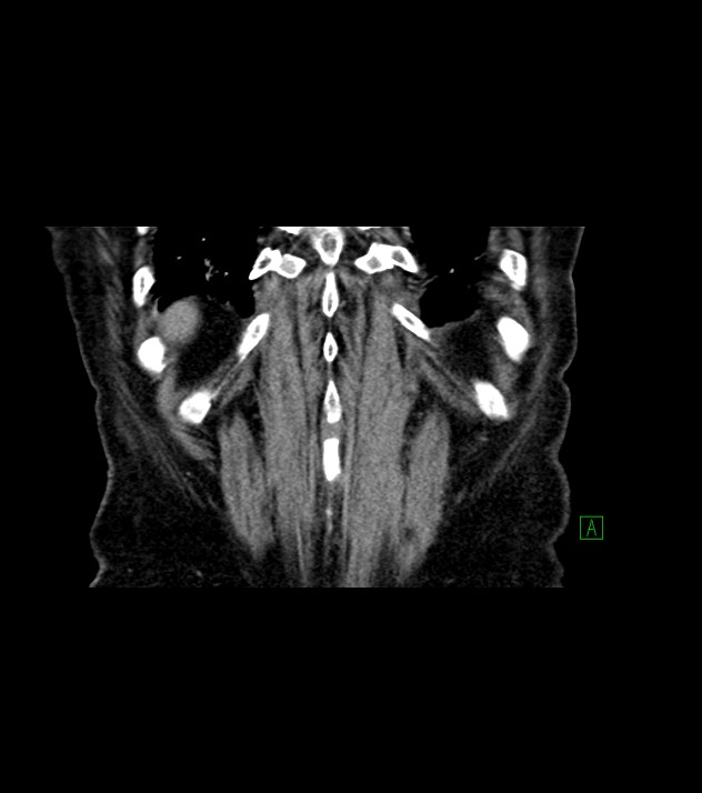 Cholangiocarcinoma with cerebral metastases (Radiopaedia 83519-98629 Coronal C+ delayed 74).jpg