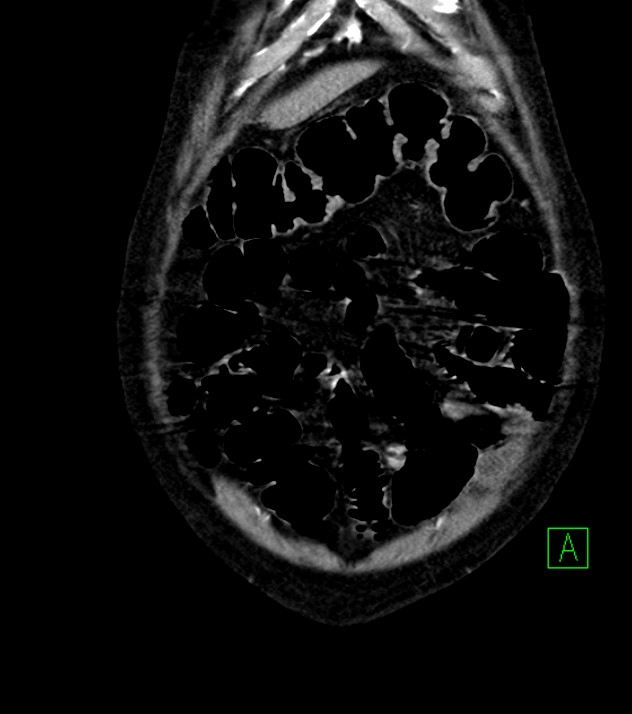 Cholangiocarcinoma with cerebral metastases (Radiopaedia 83519-98629 E 15).jpg