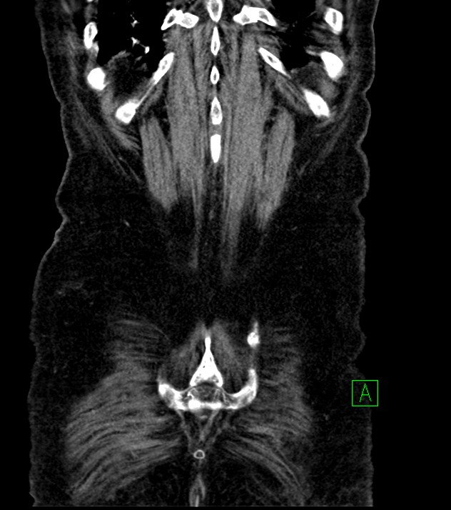 Cholangiocarcinoma with cerebral metastases (Radiopaedia 83519-98629 G 75).jpg
