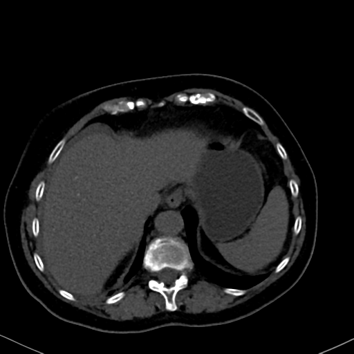 File:Cholecystitis - obstructive choledocholitiasis (CT intravenous cholangiography) (Radiopaedia 43966-47479 Axial 113).png