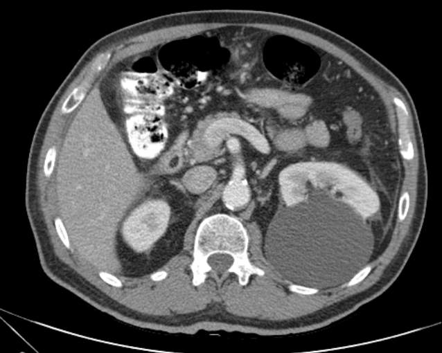 Cholecystitis - perforated gallbladder (Radiopaedia 57038-63916 A 32).jpg