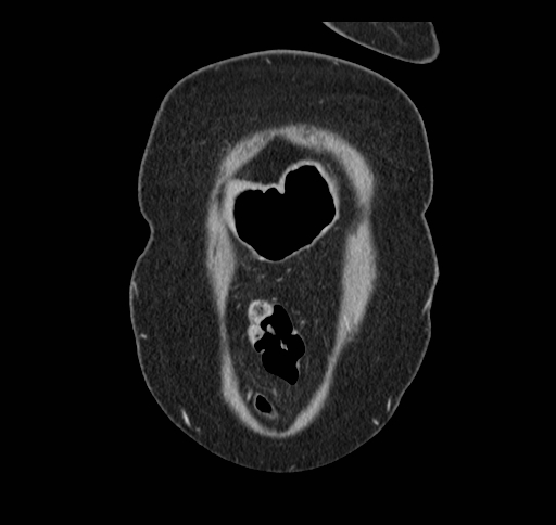 Cholecystoduodenal fistula (Radiopaedia 48959-54022 B 16).jpg