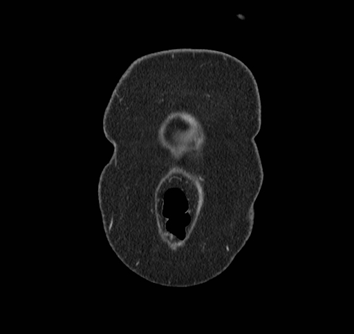 File:Cholecystoduodenal fistula (Radiopaedia 48959-54022 B 5).jpg